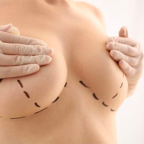 augmentation mammaire composite seins docteur jerry levy chirurgien esthetique specialiste chirurgie mammaire paris